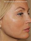 Zone treated: Face (cheekbones, jowls, nasolabial grooves, marionette lines) - Verdi Aesthetic Center