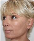 Zone treated: Face (cheekbones, jowls, nasolabial grooves, marionette lines) - Verdi Aesthetic Center