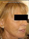 Zone treated: Face (cheekbones, jowls, nasolabial grooves, marionette lines) - Verdi Aesthetic Center