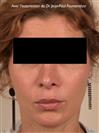 Zone treated: face, (cheekbones, jowls, nasolabial grooves, marionette lines) - Verdi Aesthetic Center
