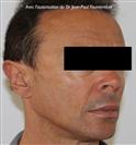 Zone treated: Face (cheekbones, jowls, nasolabial grooves, marionette lines) - Verdi Aesthetic Center