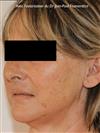 Zone treated: Face (cheekbones, jowls, nasolabial grooves, marionette lines) - Verdi Aesthetic Center