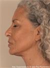 Zones treated: Face (cheekbones, jowls, nasolabial grooves, marionette lines) + Neck - Verdi Aesthetic Center