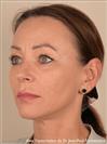 Zone treated: face, (cheekbones, jowls, nasolabial grooves, marionette lines) - Verdi Aesthetic Center