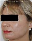 Zone treated: Face (cheekbones, jowls, nasolabial grooves, marionette lines) - Verdi Aesthetic Center