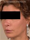 Zone treated: face, (cheekbones, jowls, nasolabial grooves, marionette lines) - Verdi Aesthetic Center