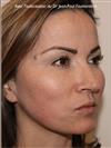 Zone treated: Face (cheekbones, jowls, nasolabial grooves, marionette lines) - Verdi Aesthetic Center