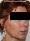 Zone treated: face, (cheekbones, jowls, nasolabial grooves, marionette lines) - Verdi Aesthetic Center