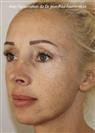 Zone treated: Face (cheekbones, jowls, nasolabial grooves, marionette lines) - Verdi Aesthetic Center