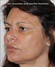 Zone treated: Face (cheekbones, jowls, nasolabial grooves, marionette lines) - Verdi Aesthetic Center