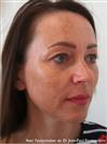 Zone treated: face, (cheekbones, jowls, nasolabial grooves, marionette lines) - Verdi Aesthetic Center