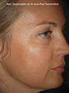 Zone treated: Face (cheekbones, jowls, nasolabial grooves, marionette lines) - Verdi Aesthetic Center