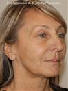 Zone treated: Face (cheekbones, jowls, nasolabial grooves, marionette lines) - Verdi Aesthetic Center