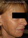 Zone treated: Face (cheekbones, jowls, nasolabial grooves, marionette lines) - Verdi Aesthetic Center