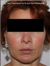 Zone treated: face, (cheekbones, jowls, nasolabial grooves, marionette lines) - Verdi Aesthetic Center