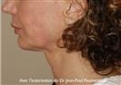 Zone treated: Face (cheekbones, jowls, nasolabial grooves, marionette lines + Neck - Verdi Aesthetic Center