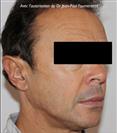 Zone treated: Face (cheekbones, jowls, nasolabial grooves, marionette lines) - Verdi Aesthetic Center