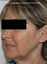 Zone treated: Face (cheekbones, jowls, nasolabial grooves, marionette lines) - Verdi Aesthetic Center