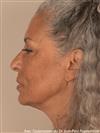 Zones treated: Face (cheekbones, jowls, nasolabial grooves, marionette lines) + Neck - Verdi Aesthetic Center