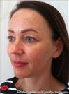 Zone treated: face, (cheekbones, jowls, nasolabial grooves, marionette lines) - Verdi Aesthetic Center