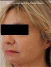 Zone treated: Face (cheekbones, jowls, nasolabial grooves, marionette lines) - Verdi Aesthetic Center