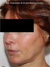 Zone treated: face, (cheekbones, jowls, nasolabial grooves, marionette lines) - Verdi Aesthetic Center
