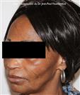 Zone treated: Face (cheekbones, jowls, nasolabial grooves, marionette lines) - Verdi Aesthetic Center