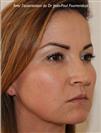 Zone treated: Face (cheekbones, jowls, nasolabial grooves, marionette lines) - Verdi Aesthetic Center