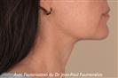 Double crossing technique to erase the platysmal bands and recreate the cervical-chin angle. - Verdi Aesthetic Center