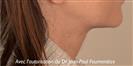 Double crossing technique to erase the platysmal bands and recreate the cervical-chin angle. - Verdi Aesthetic Center
