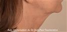Double crossing technique to erase the platysmal bands and recreate the cervical-chin angle. - Verdi Aesthetic Center