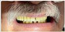 Dental Implants - Fulop Clinic
