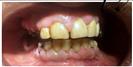 Dental Implants - Fulop Clinic