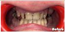 Dental Implants - Fulop Clinic