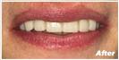Porcelain Veneers - Fulop Clinic