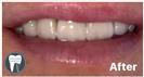 Porcelain Veneers - Fulop Clinic