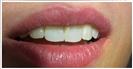 Porcelain Veneers - Fulop Clinic