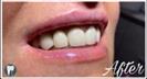 Porcelain Veneers - Fulop Clinic