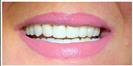 Porcelain Veneers - Fulop Clinic