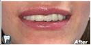 Porcelain Veneers - Fulop Clinic