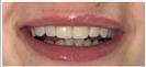 Porcelain Veneers - Fulop Clinic