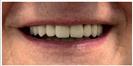Porcelain Veneers - Fulop Clinic