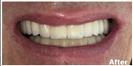 Porcelain Veneers - Fulop Clinic