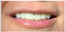 Porcelain Veneers - Fulop Clinic