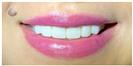 Porcelain Veneers - Fulop Clinic