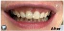 Porcelain Veneers - Fulop Clinic