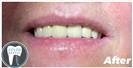 Porcelain Veneers - Fulop Clinic