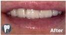Porcelain Veneers - Fulop Clinic