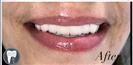 Porcelain Veneers - Fulop Clinic