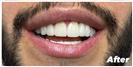 Porcelain Veneers - Fulop Clinic